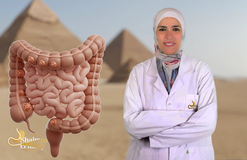 أفضل دكتور أورام القولون في مصر
