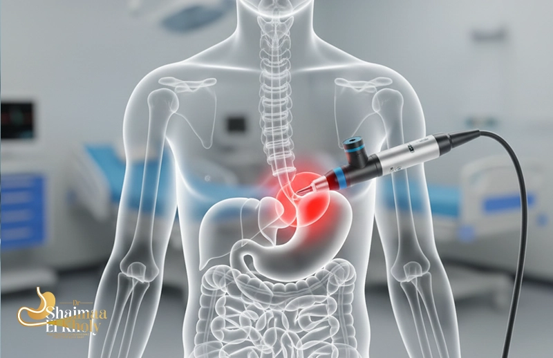 عملية ارما لعلاج ارتجاع المرئ